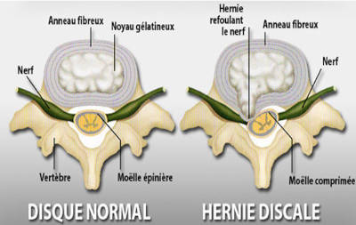 Hernie discale