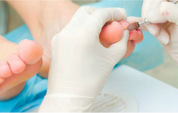 Etablir un diagnostic pour mieux soigner une mycose des pieds