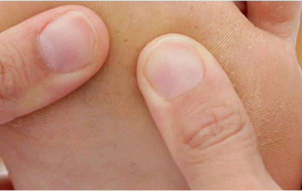 Comment éviter d’attraper une infection des ongles?