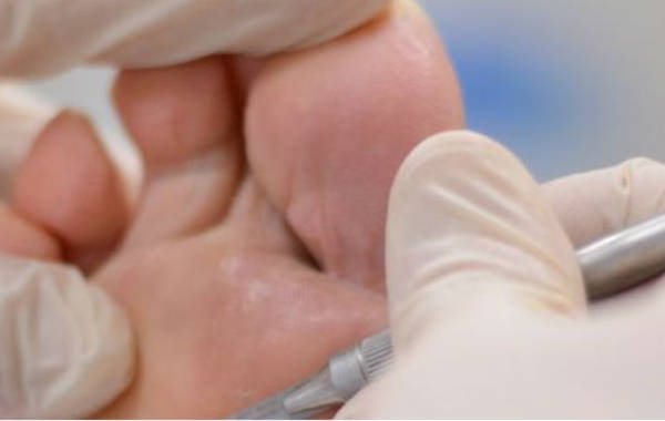Traitement des champignons sur l’ongle du pied