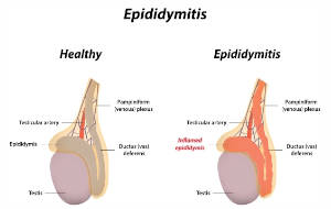 Qu’est-ce que l’Épididymite ou l’inflammation de l’épididyme?