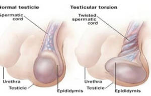 Torsion testiculaire