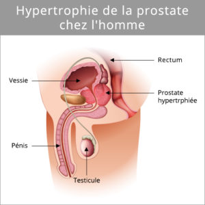prostaze-hypertrophie-de-la-prostate