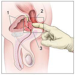 Toucher rectal de la prostate