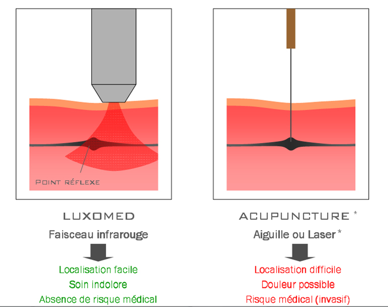 luxopuncture-versus-akupunktur