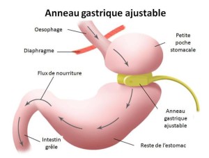 operation-gastric-ring-adjustable