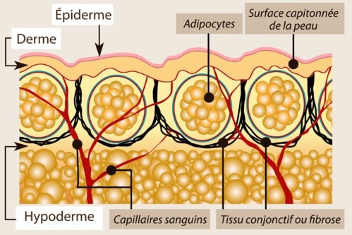 Cellulite fibreuse